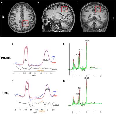 Reduced GABA concentration in patients with white matter hyperintensities